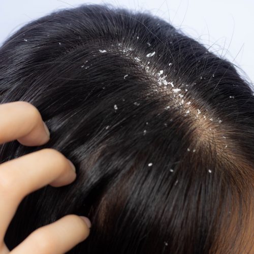 Dandruff,Problem.,A,Girl,With,Itchy,Head.,Dandruff,On,The